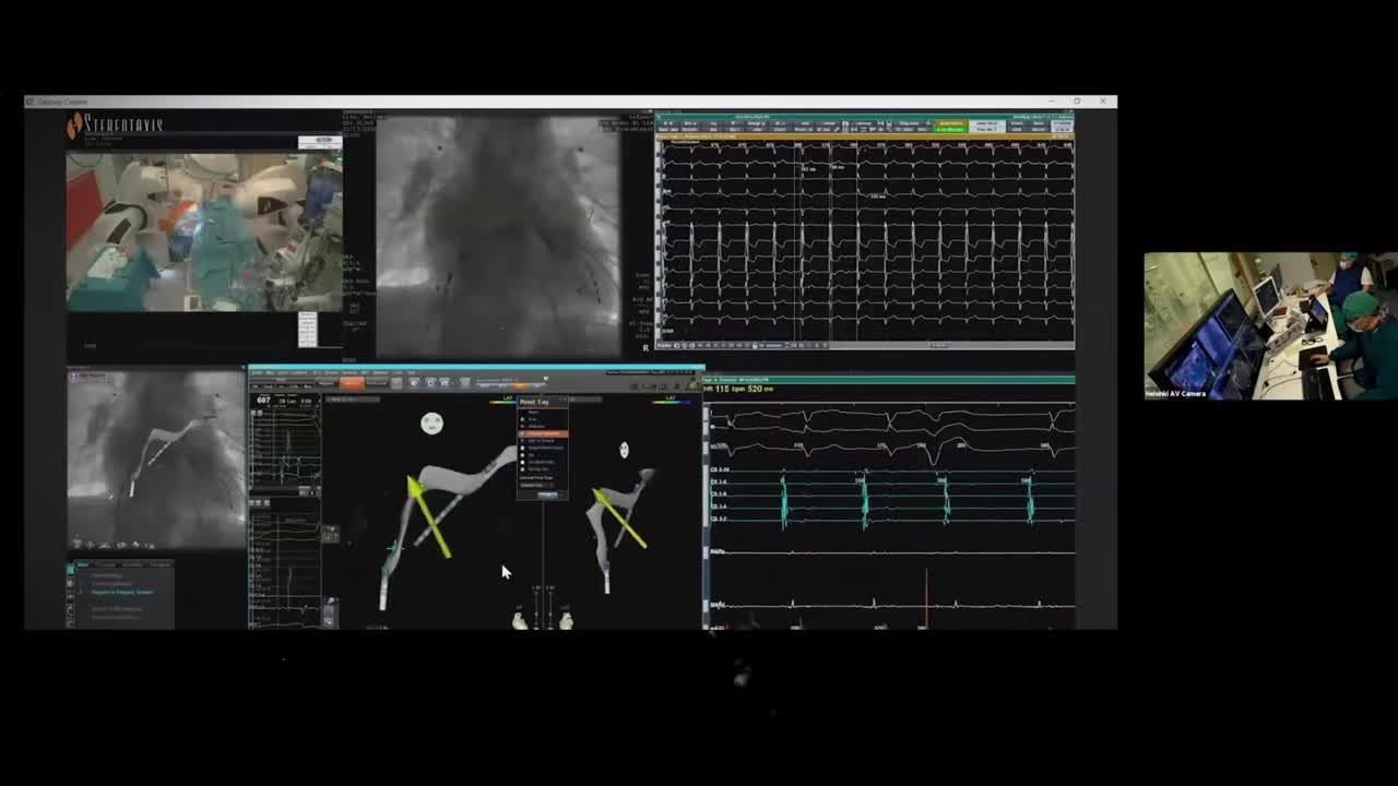 Stereotaxis robotic cardiac ablation software interface showing 3D heart mapping, fluoroscopy imaging, and EKG data during a procedure